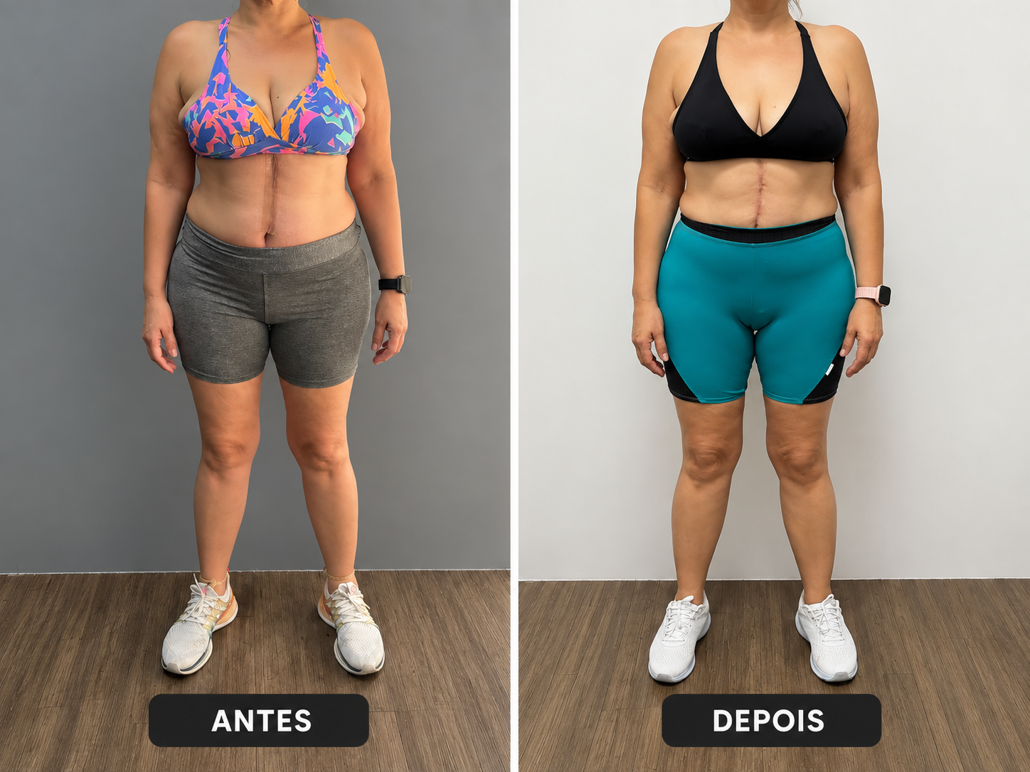 Comparativo 05 de antes e depois, vista frontal